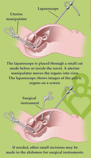 Minimally Invasive Fertility Surgery - Laparoscopy - Hysteroscopy