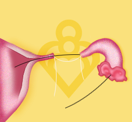 tubal reversal surgery anastomosis fertility