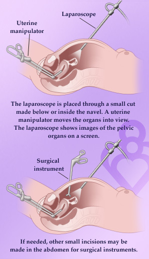 laparoscopy