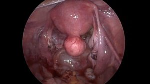 penduculated subserous uterine fibroid