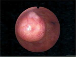 intracavity fibroid