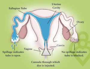 hsg hysterosalpingogram test fertility tubes testing fallopian dye procedure uterus blockage blood female tests infertility open pregnancy done answers hystero