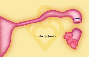Fimbriectomy