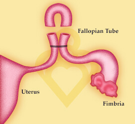 Pomeroy Technique Baton Rouge Fertility Clinic Tubal Ligation