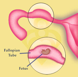 Ectopic pregnancy