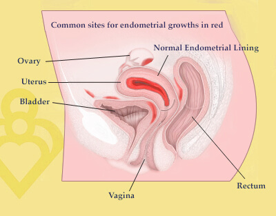 Common sites for endometriosis