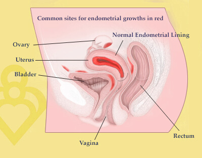 Endometriosis