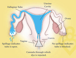 hysterosalpingogram HSG test for blocked tubes