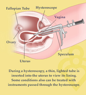 hysteroscopy