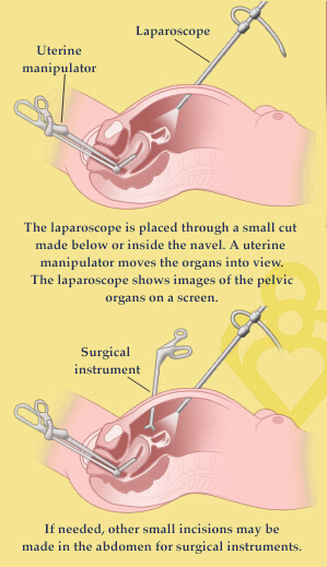 Laparoscopy