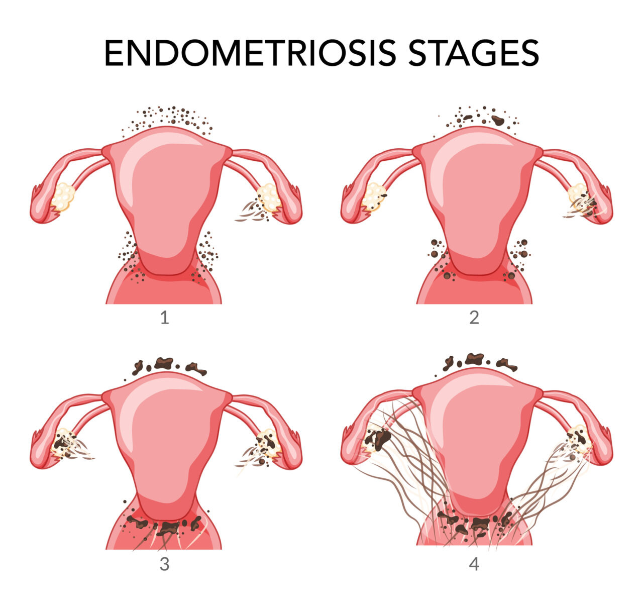 What to Know About Stages of Endometriosis - Fertility Answers